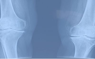 ข้อเข่าเสื่อมควรเลือกทานอะไรดี