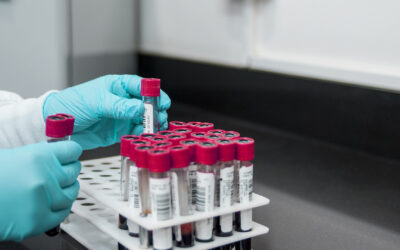 โรคแพ้ภูมิตัวเอง หรือ SLE คืออะไร?